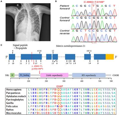 A Novel Nonsense MMP21 Variant Causes Dextrocardia and Congenital Heart Disease in a Han Chinese Patient